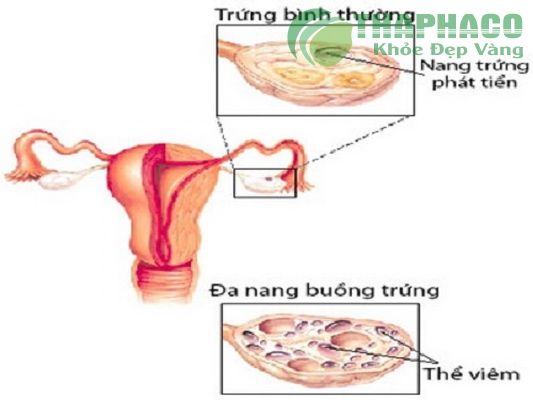 Hình ảnh buồng trứng đa nang.