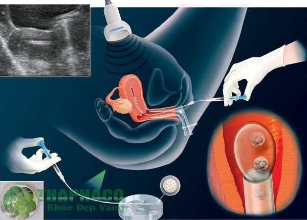 Công dụng của củ gai giúp mẹ bầu chuyển phôi thành công