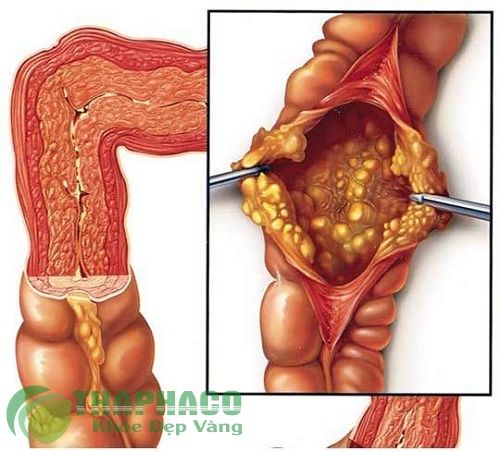 Trị đại tiện ra máu bằng cây cỏ mực