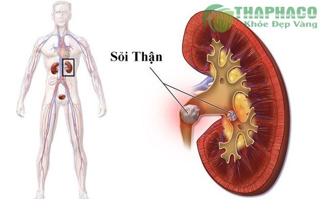 Bột kim tiền thảo trị sỏi thận