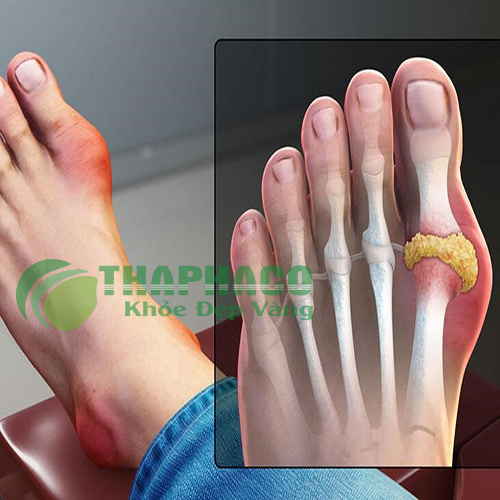 Bệnh gout 