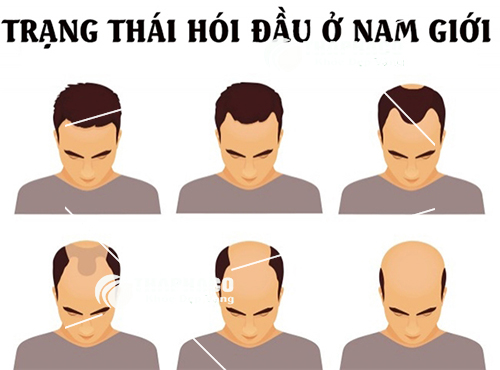 Những trạng thái rụng tóc ở nam giới