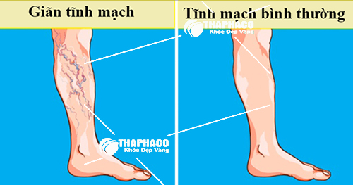 Bệnh suy giãn tĩnh mạch có nguy hiểm không ?